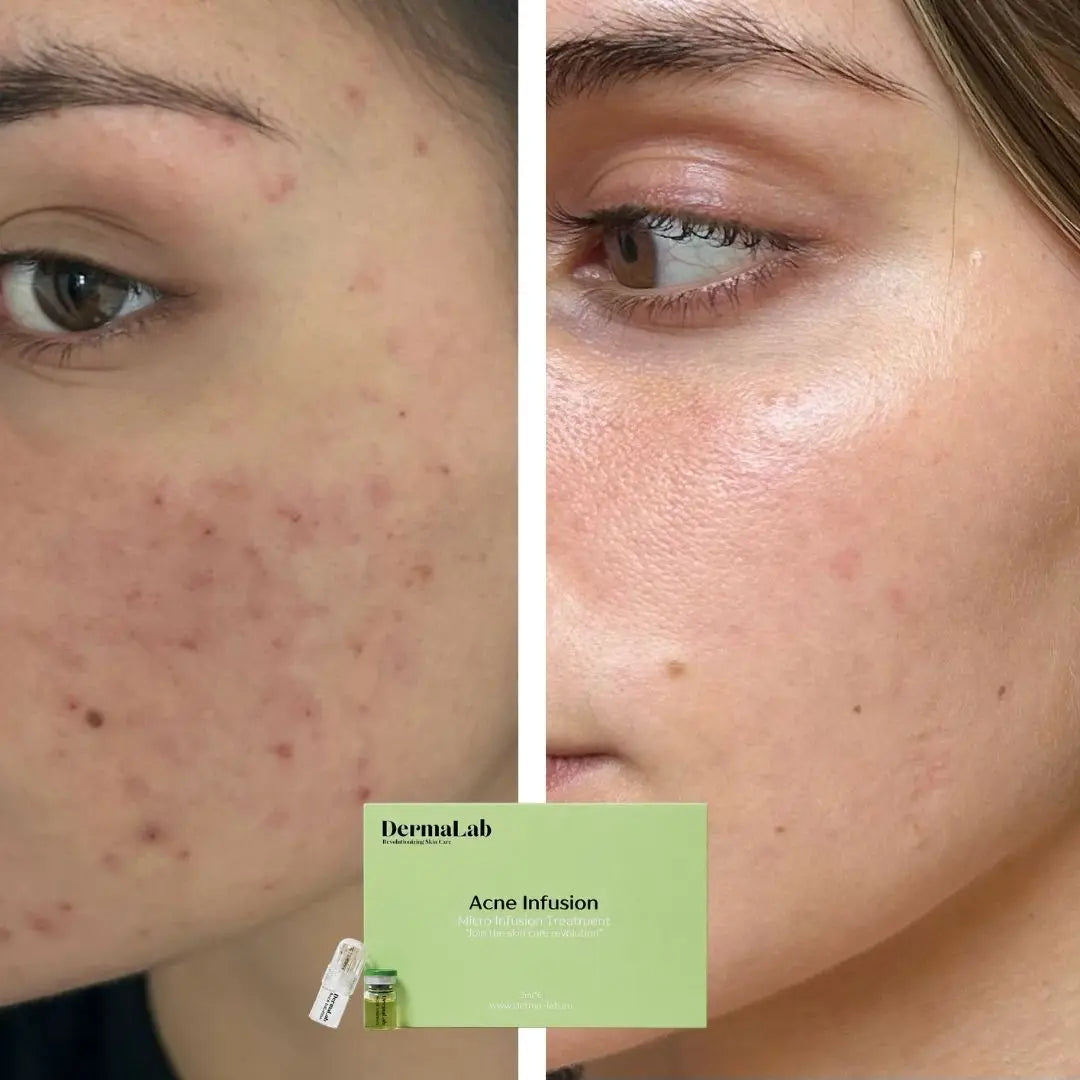 6 redenen waarom je acne blijft terugkomen (en wat écht helpt)