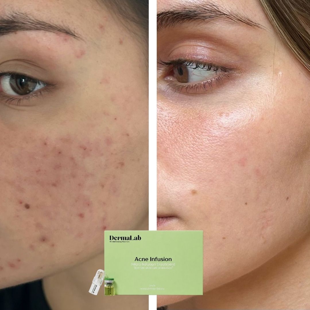 6 redenen waarom je acne blijft terugkomen (en wat écht helpt)