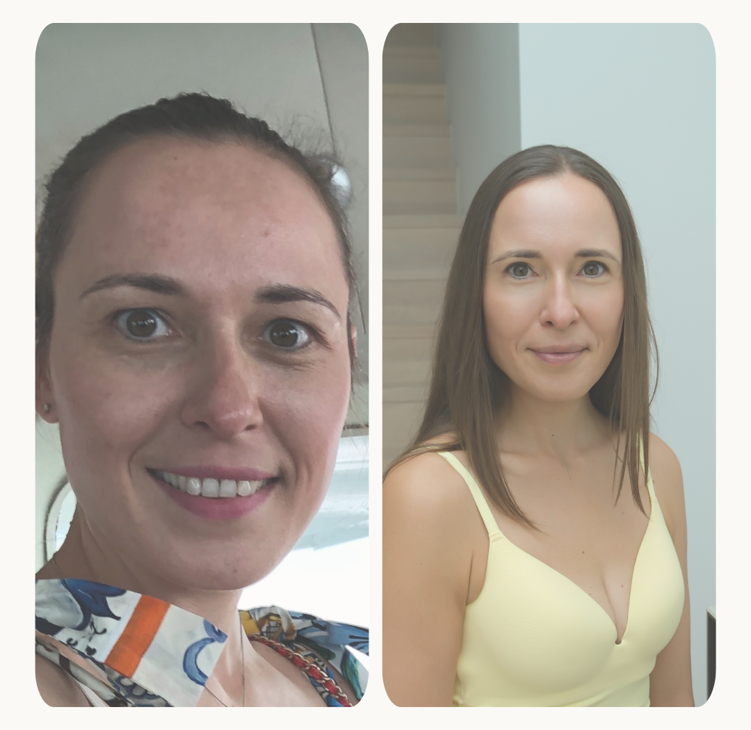 Wat is melasma? En 8 tips om pigmentvlekken écht te verminderen