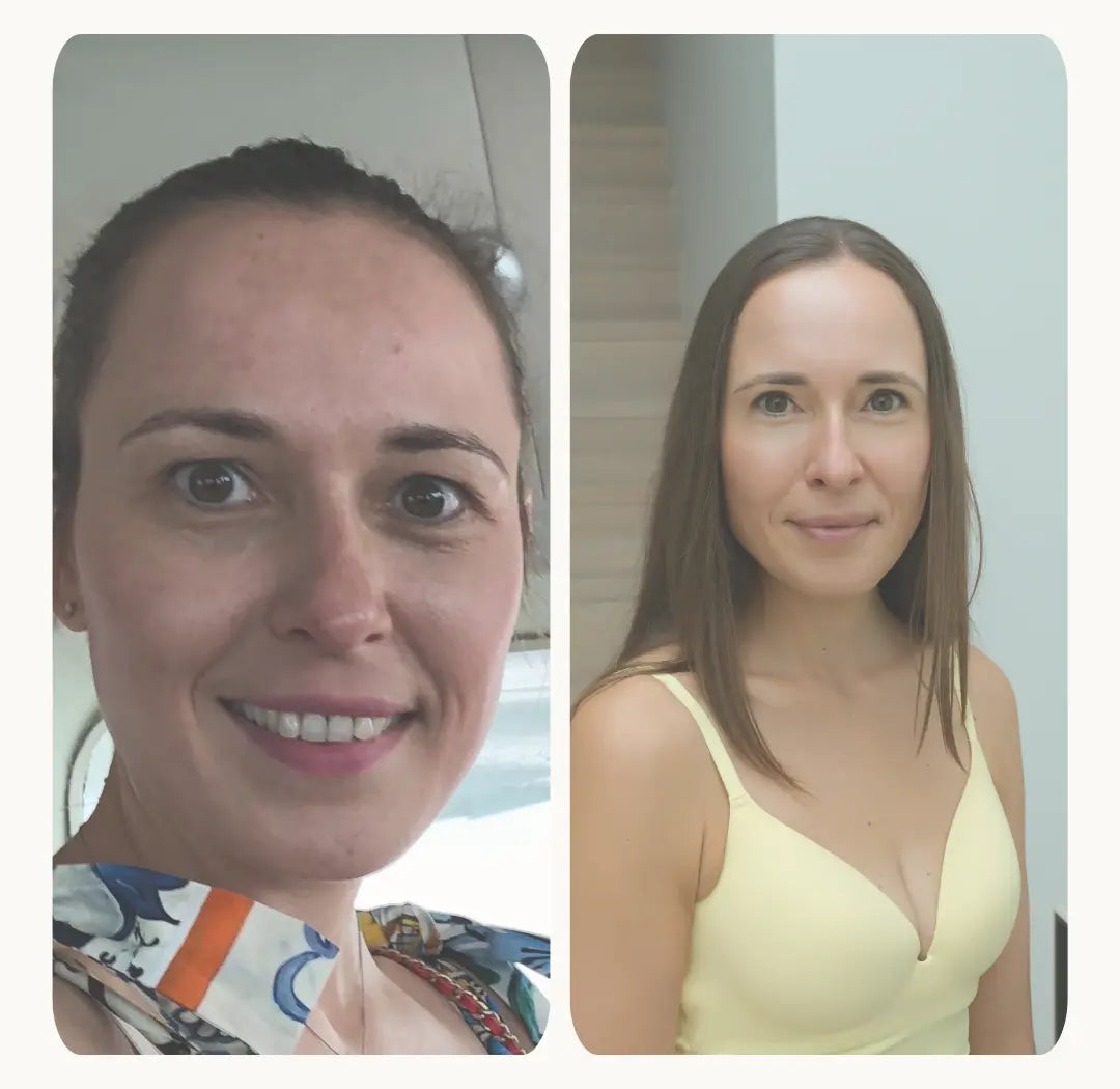 Wat is melasma? En 8 tips om pigmentvlekken écht te verminderen