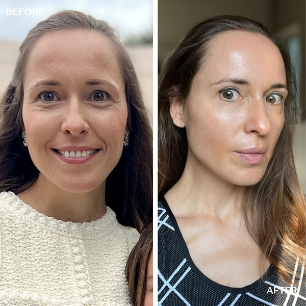 ANTI-AGING Micro Infusion Treatment 3-Month Plan