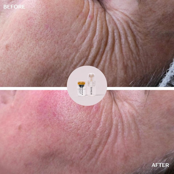 ANTI-AGING Micro Infusion Treatment 3-Month Plan