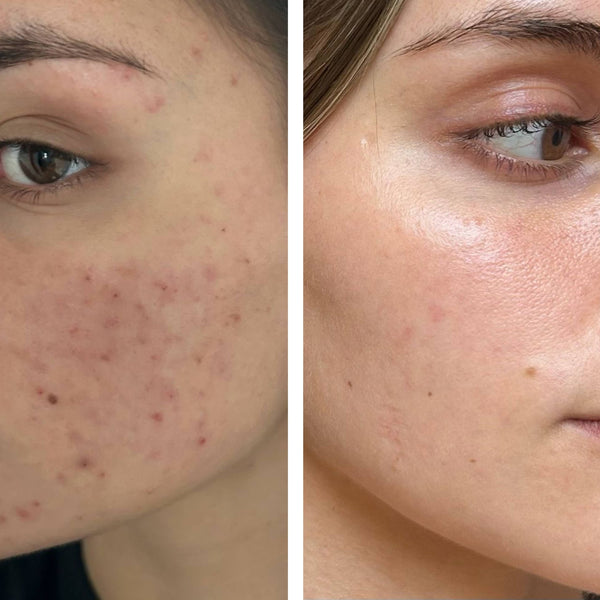 Acne Infusion 8 week plan