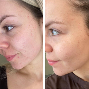 Acne Infusion 8 week plan
