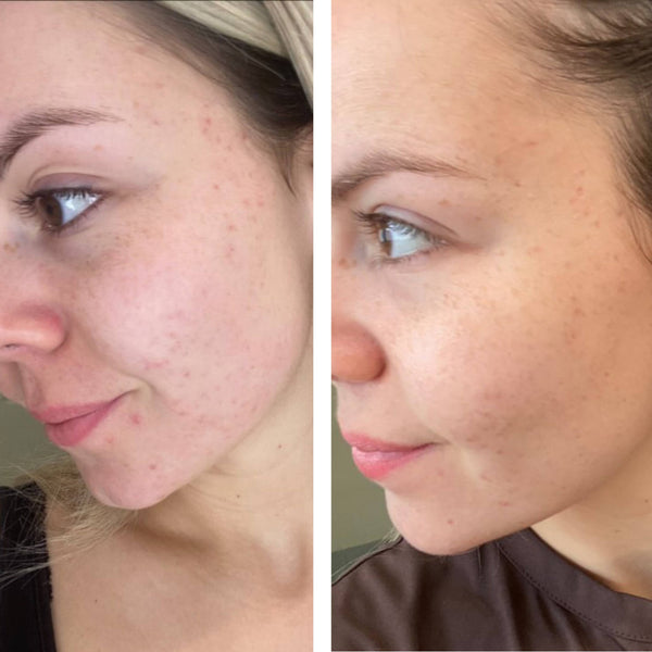 Acne Infusion 8 week plan