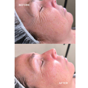 ANTI-AGING Micro Infusion Treatment 1 single application