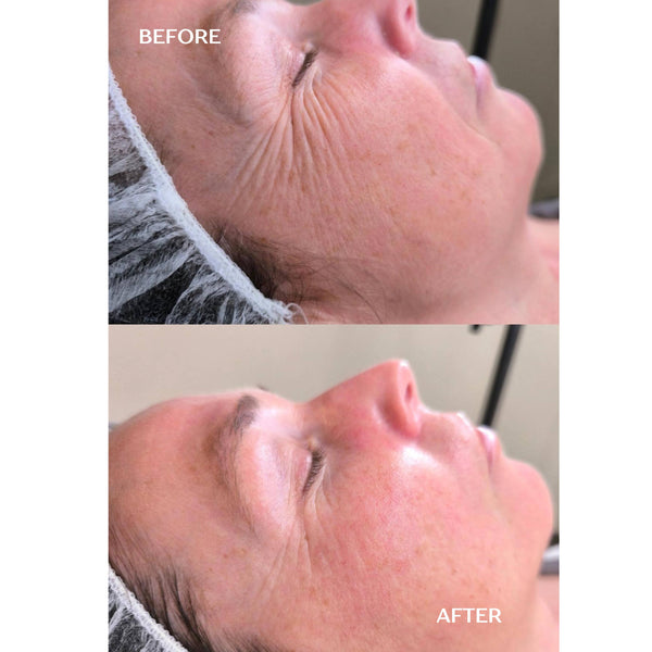 ANTI-AGING Micro Infusion Treatment 1 single application