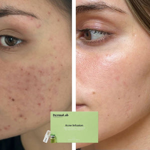 Acne Infusion