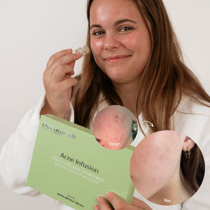 Acne Infusion