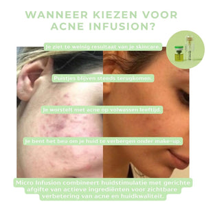 Acne Infusion
