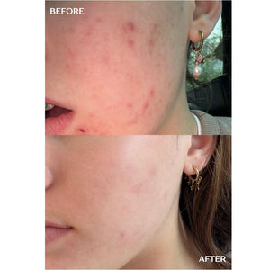 Acne Infusion