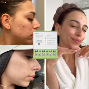 Acne Infusion