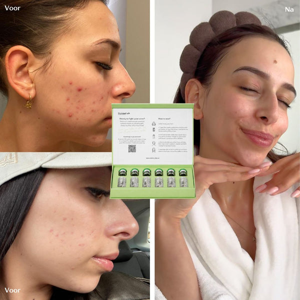 Acne Infusion