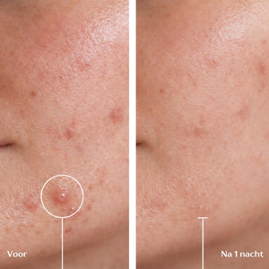 Acne Micropatches
