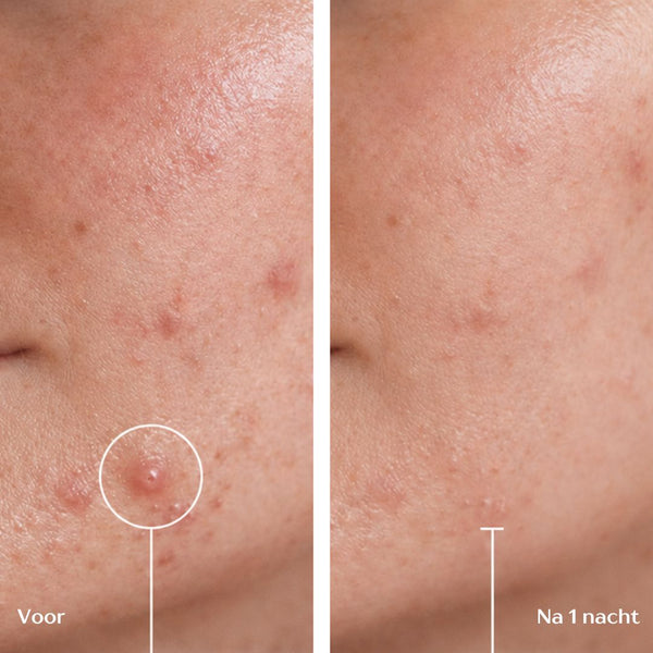 Acne Micropatches
