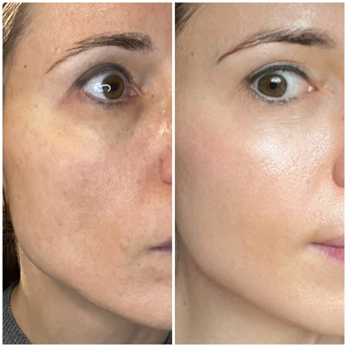 ANTI-AGING Micro Infusion Treatment 1-Month Plan
