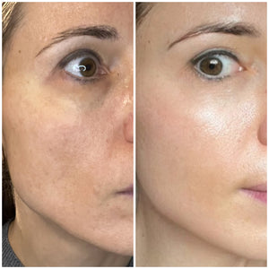 ANTI-AGING Micro Infusion Treatment 1 single application