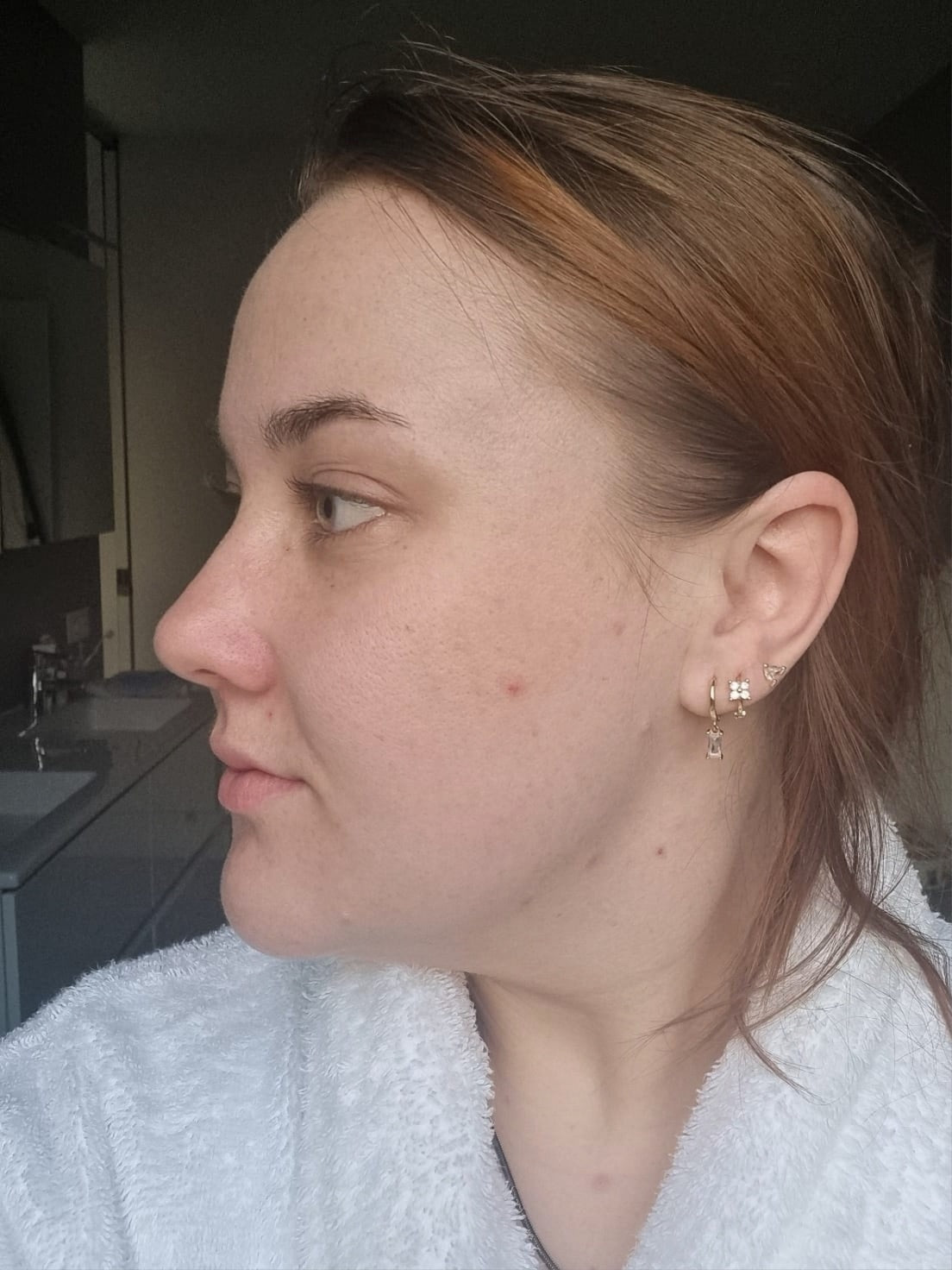 Acne Micro Infusion