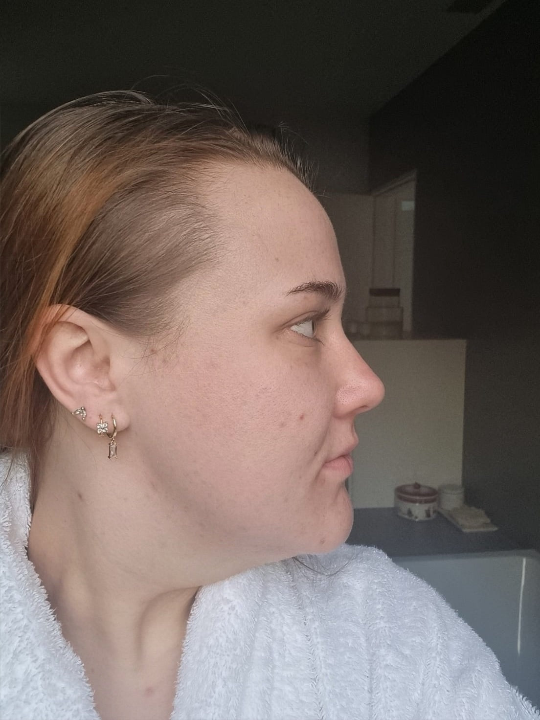 Acne Micro Infusion