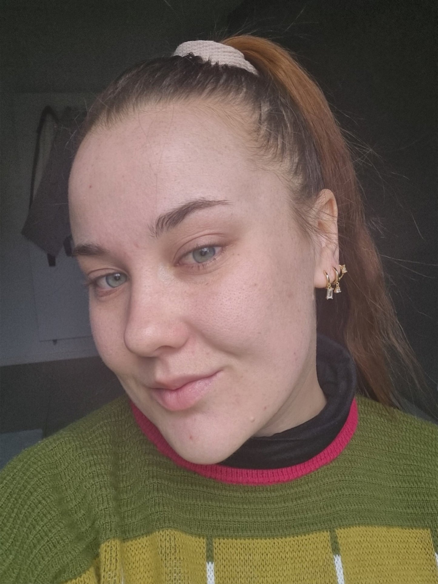 Acne Micro Infusion